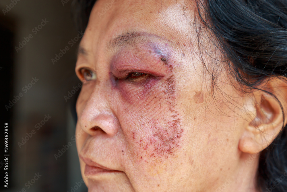 Obraz premium Elderly injury to the eyelid