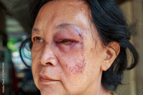 Elderly injury to the eyelid