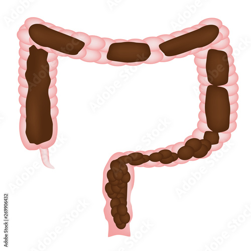 Constipation. Feces in colon. Infographics. Vector illustration on isolated background.