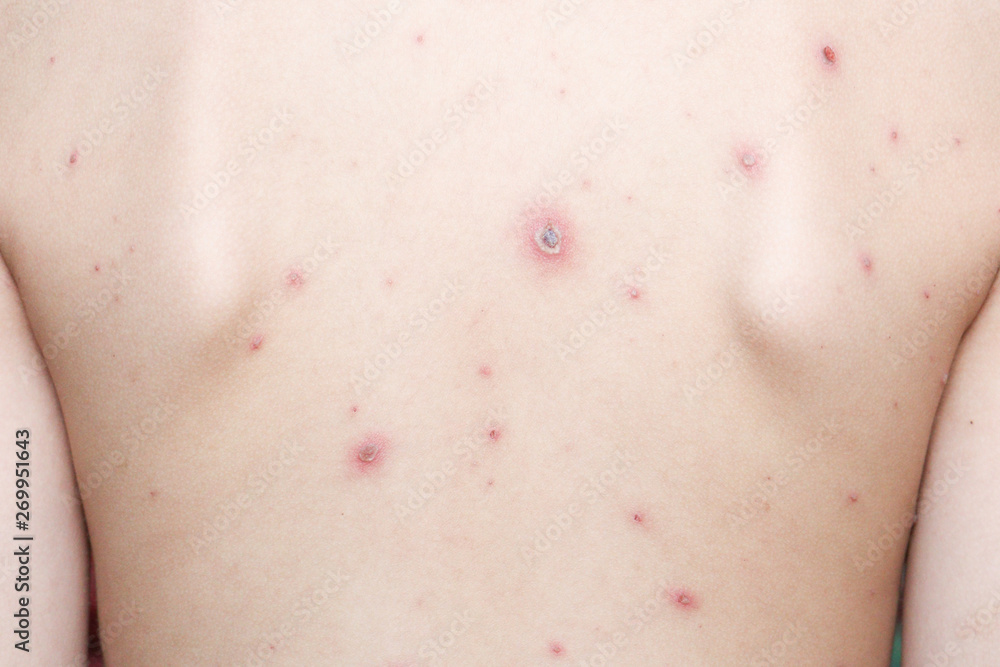 Chicken pox rash on young boy body.Chickenpox is an infection caused by the varicella zoster virus. It begins as a blister-like rash that originates on the face and trunk Chicken pox rash on young boy body.Chickenpox is an infection caused by the varicella zoster virus. It begins as a blister-like rash that originates on the face and trunk