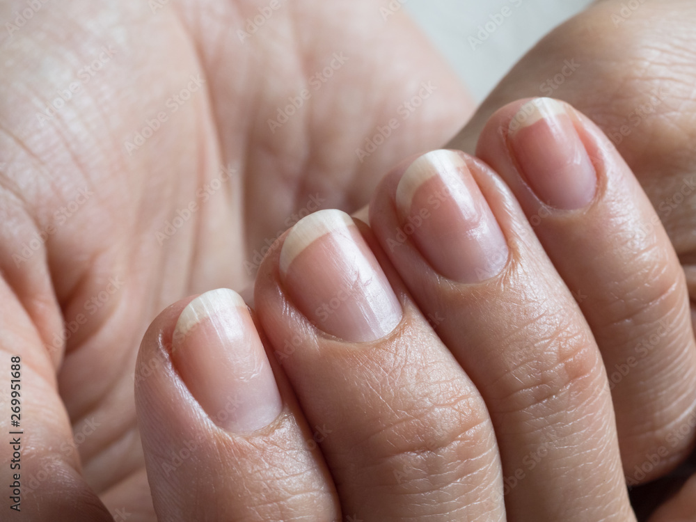 hydrogen peroxide to remove acrylic nails｜TikTok Search