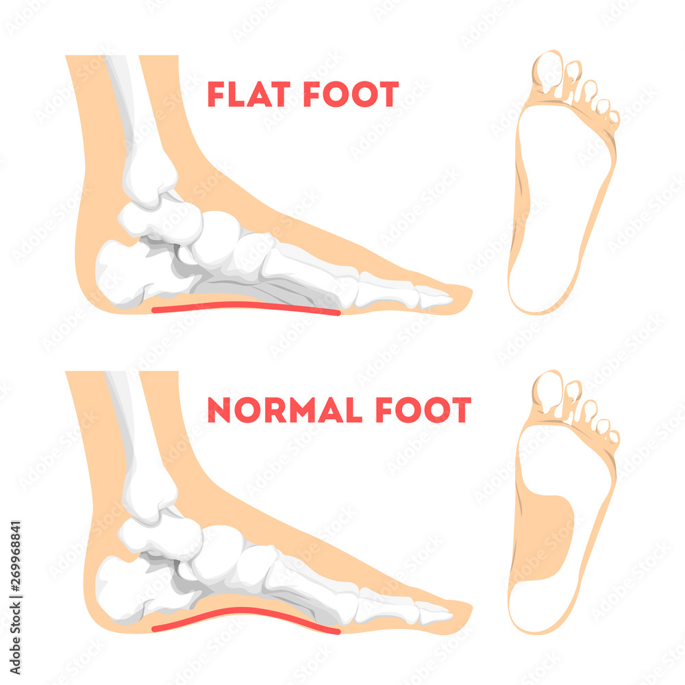 Human Foot Pathology Infographic Flat Foot Anatomy Stock Vector pathologies-flat-feet