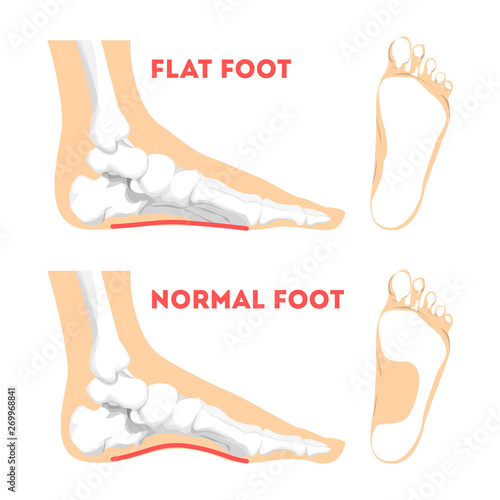 Human foot pathology infographic. Flat foot anatomy