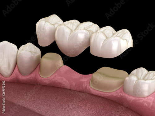 Dental bridge of 3 teeth over molar and premolar. Medically accurate 3D illustration of human teeth treatment photo