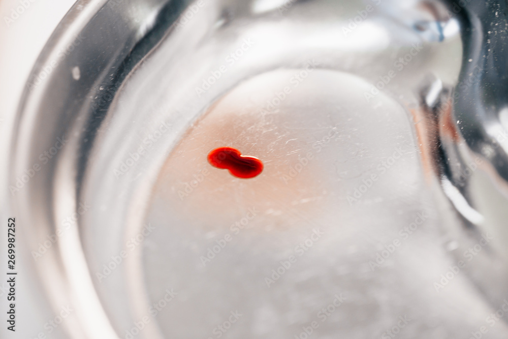 Fototapeta premium A blood test is a necessary diagnostic tool - it allows you to quickly or as accurately as possible to either refute the diagnosis