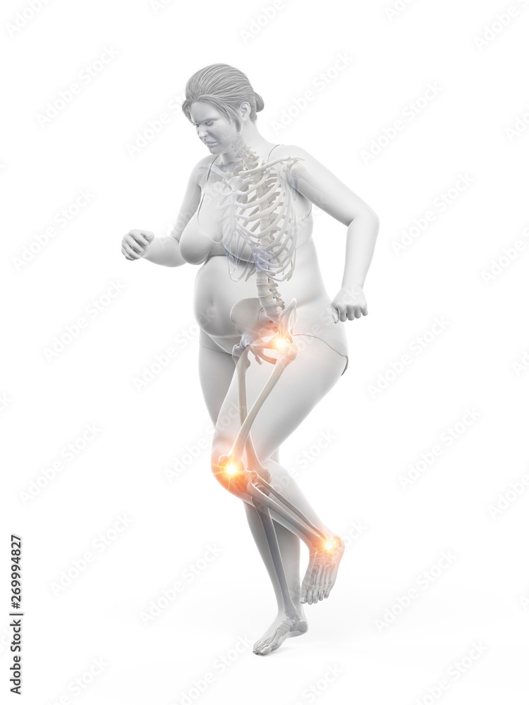 3d rendered medically accurate illustration of an obese womans 3d rendered medically accurate illustration of an obese womans