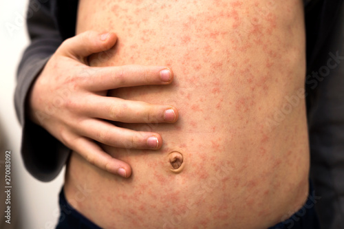 Sick child body, stomach with red rush spots from measles or chicken pox. Contagious child diseases and treatment. photo