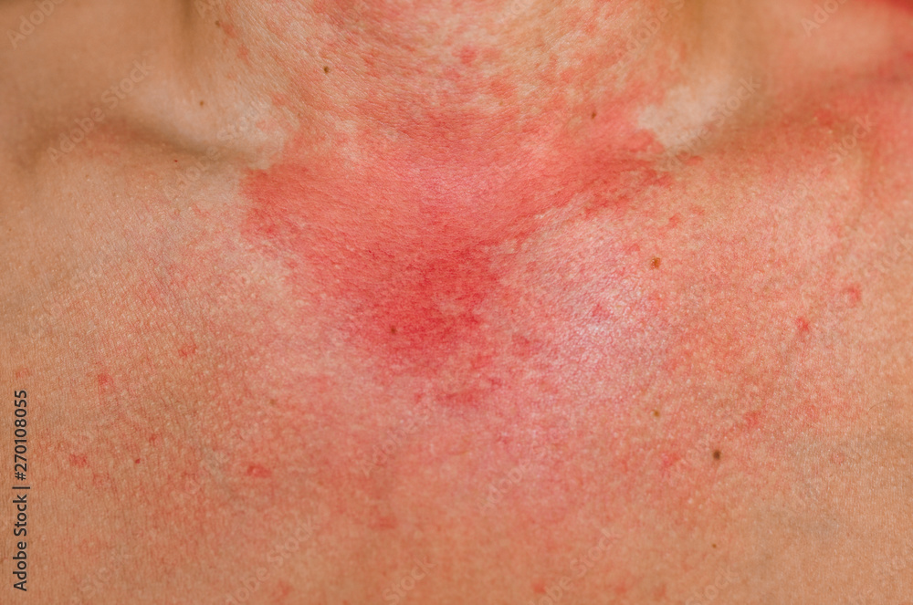 Allergic skin reaction on the man neck and face - red rash