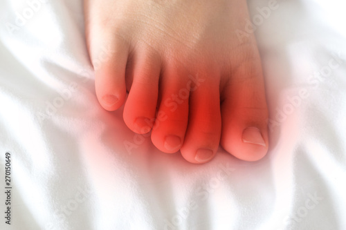 Foot of female Asia young adult with red spot as suffer from feet diseases photo