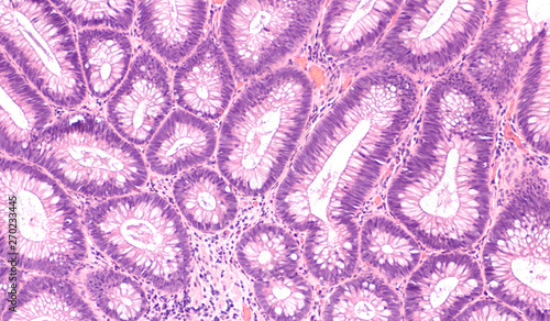 Microscopic (histology) of tubular adenoma. Adenomas are premalignant (precancerous) polyps of colon and rectum. Colonoscopy can prevent cancer by removing adenomas before they transform to cancer. photo
