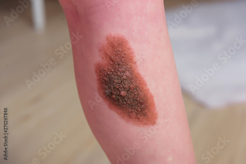 A large birthmark on a person's leg. Pigmented formation on the skin. Benign papilloma