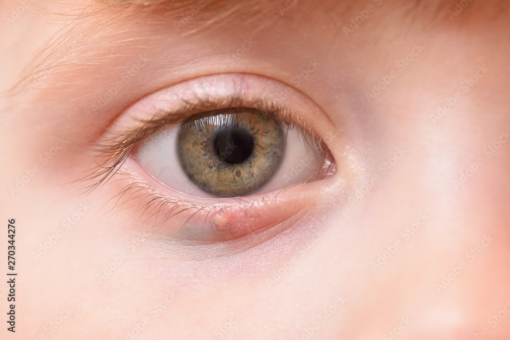 Children's right eye and swollen barley on the lower eyelid. Macro, close-up Children's right eye and swollen barley on the lower eyelid. Macro, close-up