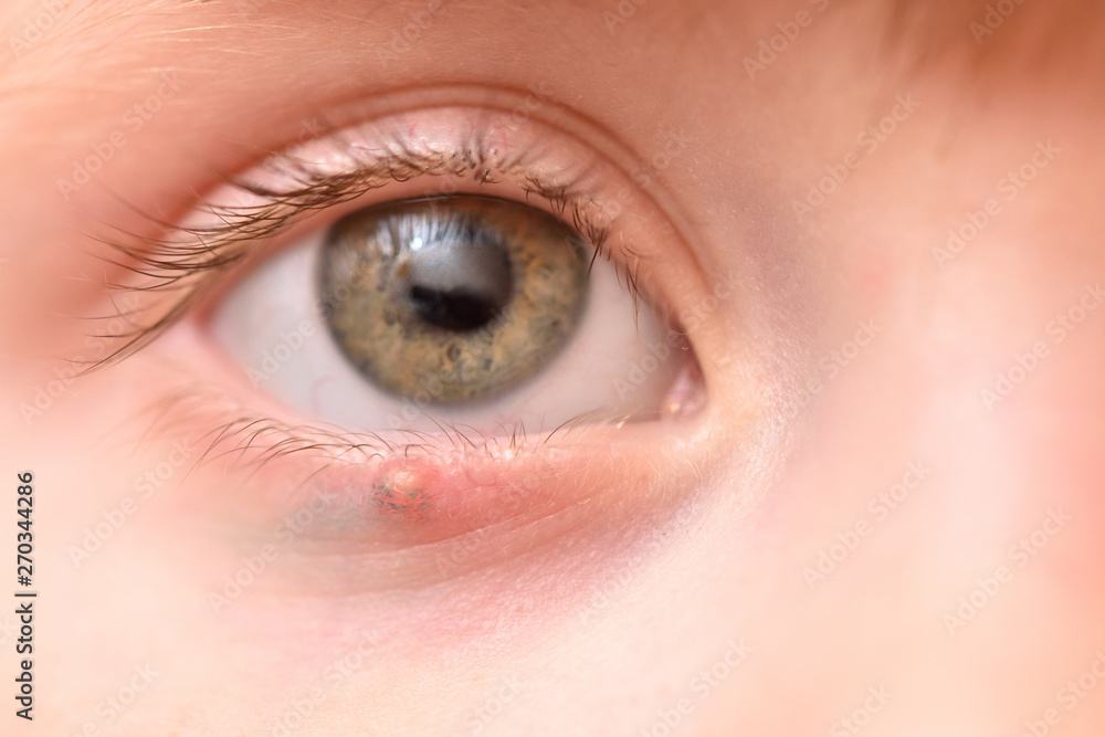 Children's right eye and swollen barley on the lower eyelid. Macro, close-up Children's right eye and swollen barley on the lower eyelid. Macro, close-up