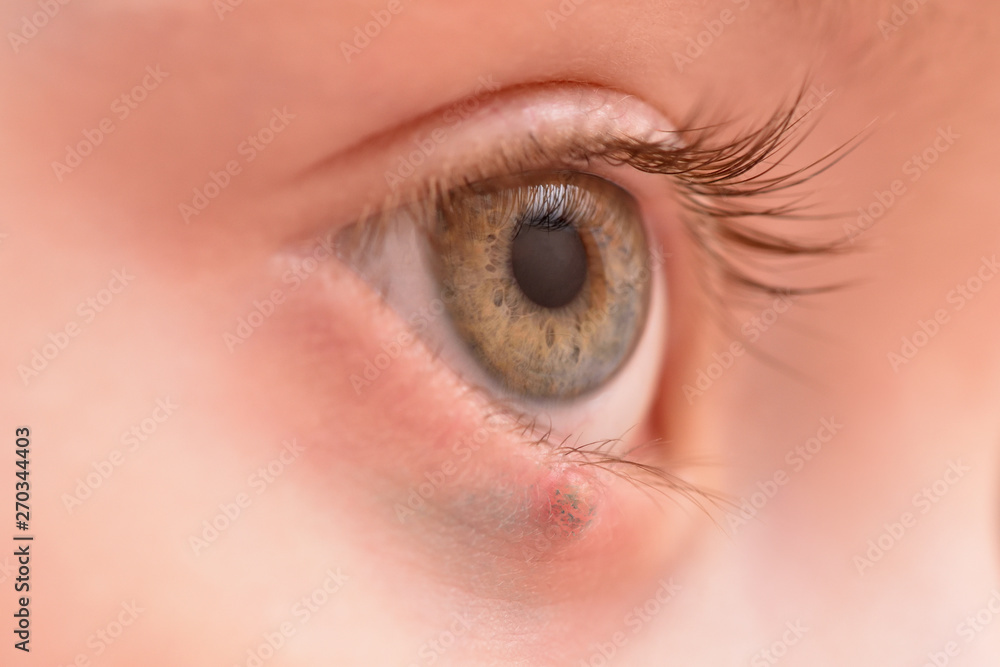 Obraz premium Children's right eye and swollen barley on the lower eyelid. Macro, close-up