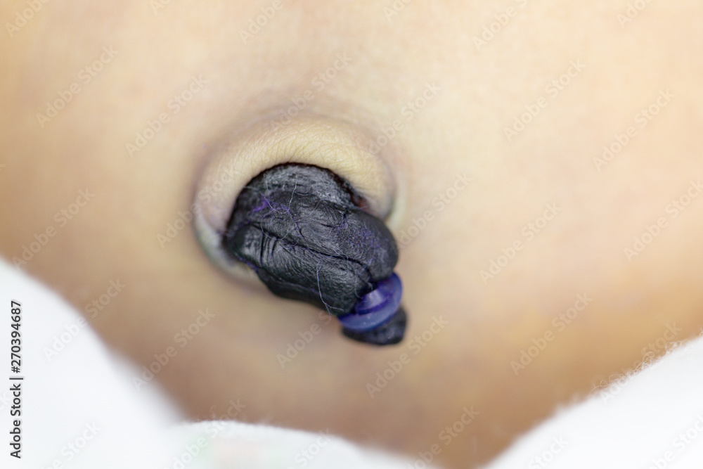 Baby umbilical cord of baby newborn in hospital. Baby umbilical cord of baby newborn in hospital.