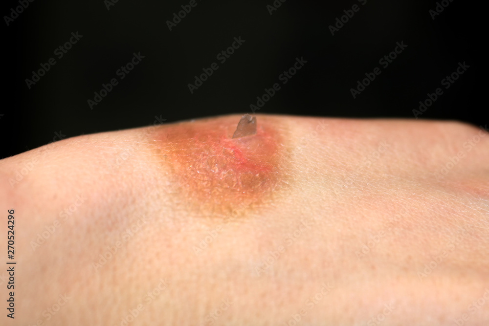 Fototapeta premium Burn on the hand. Brown spot on skin after burn
