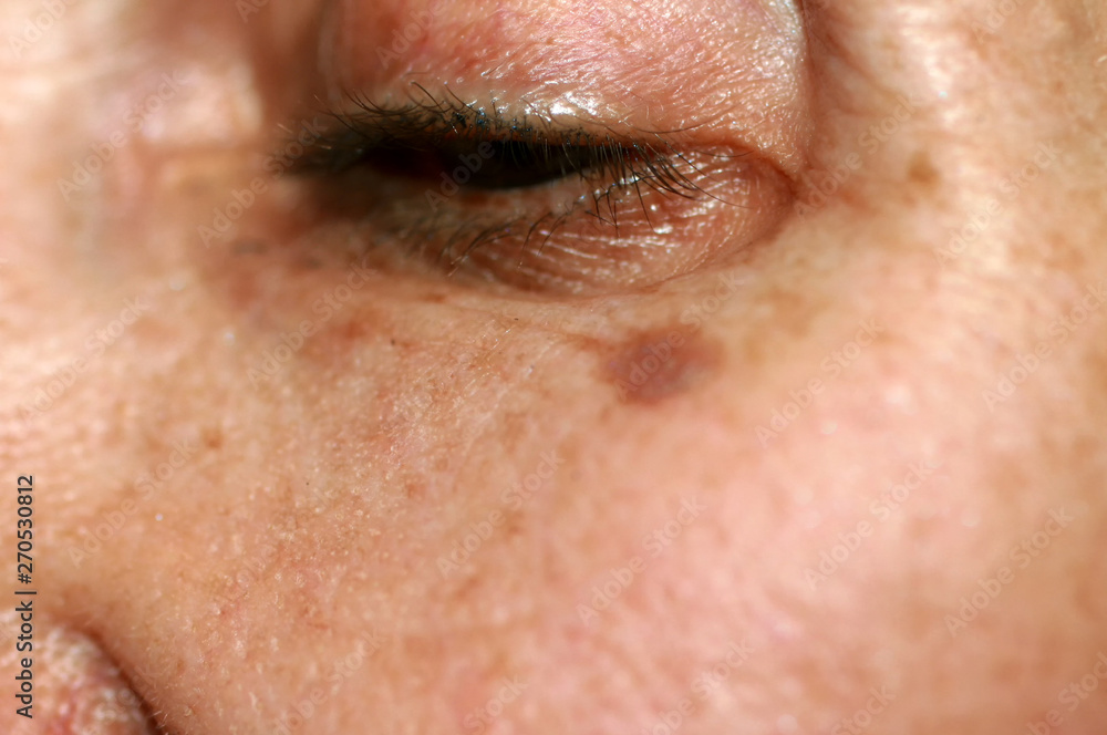 Pigmentation on the face. Brown spot on cheek. Pigment spot on the skin. Pigmentation on the face. Brown spot on cheek. Pigment spot on the skin.