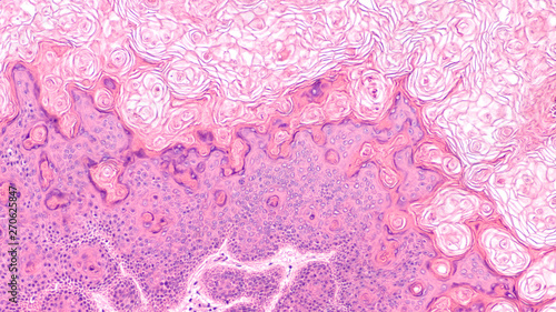 Microscopic image of a proliferating epidermoid cyst, a type of epidermal inclusion cyst (commonly called 