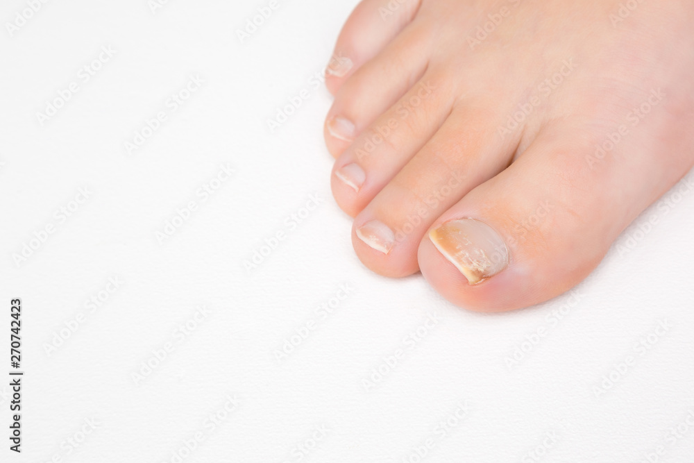 Foot on white background. Dry, damaged toe nails. Woman's issues. Problem and solution. Closeup. Copy space. Empty place for text. Foot on white background. Dry, damaged toe nails. Woman's issues. Problem and solution. Closeup. Copy space. Empty place for text.