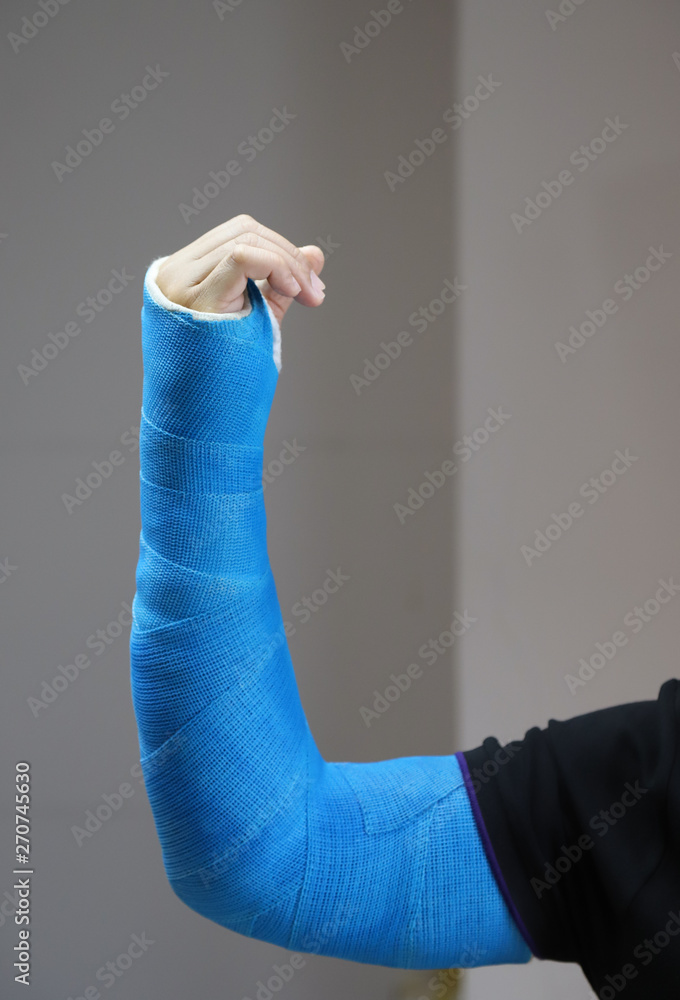 Closeup of Asian man's arm with long arm plaster, fiberglass cast therapy  cover by blue elastic bandage. Vertical view. Stock-Foto | Adobe Stock