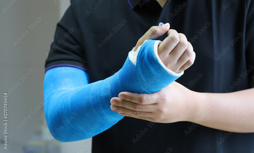 Closeup of Asian man's arm with long arm plaster, fiberglass cast therapy  cover by blue elastic bandage after sport injury. Stock-Foto | Adobe Stock