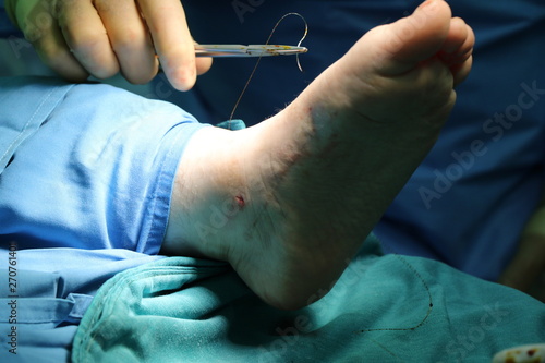 Suturing foot surgery