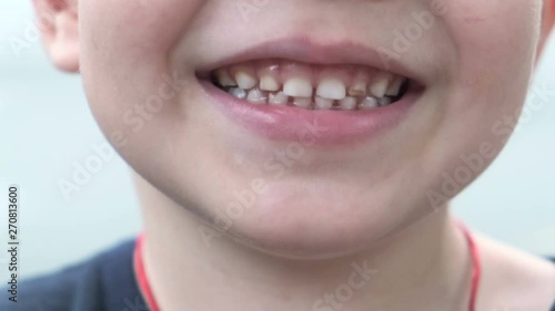 The teeth and smile of a little boy on a white background, close-up photo