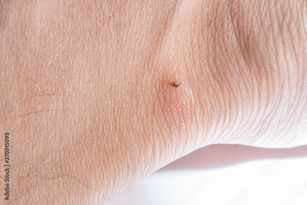 Fototapeta premium Sucking tick Macro photo on human skin