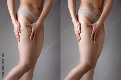 The woman shows cellulite and smooth and delicate skin on her legs. The concept of aesthetic medicine and skin imperfections. Before and after