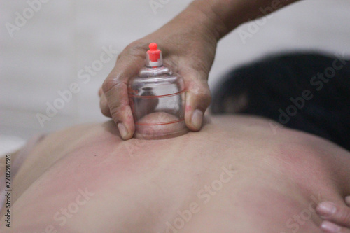 A person receiving chinese medicine treatment with suction cups. Vacuum cup of medical cupping therapy on back. photo