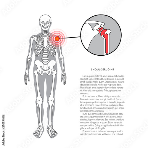 Shoulder prosthesis, vector banner with place for text. Medical illustration