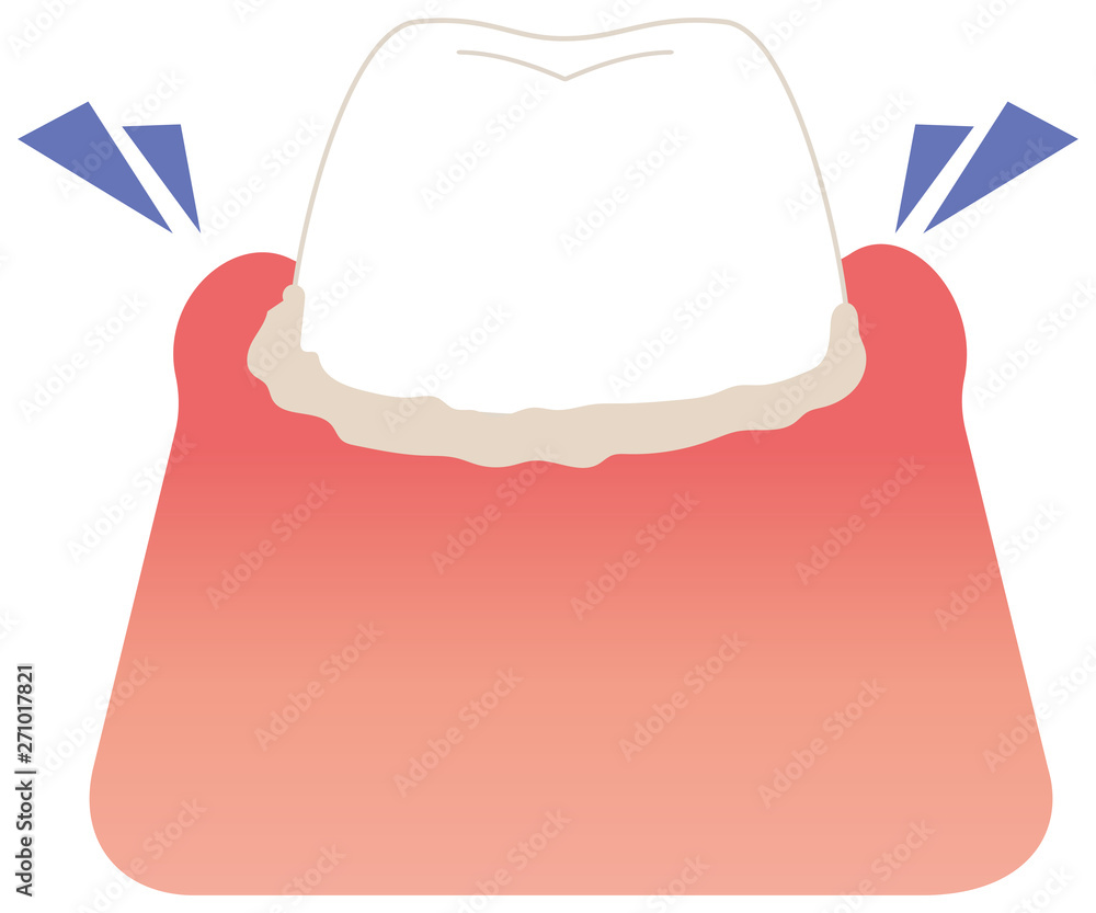 腫れている歯垢がたまった歯 イラスト Stock Vector Adobe Stock