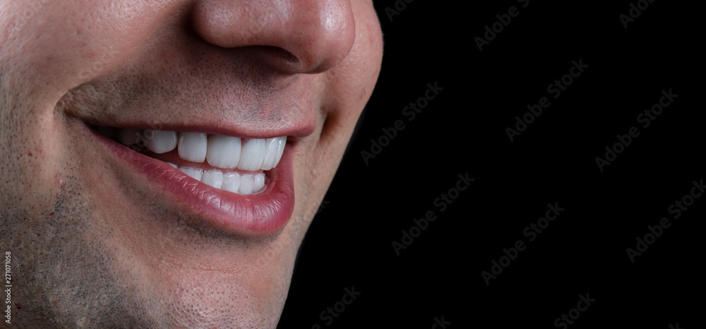 Obraz premium full arch ceramic veneers