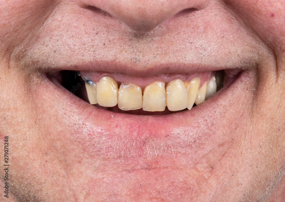 Obraz premium full arch ceramic veneers