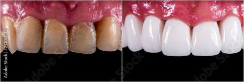 full arch ceramic veneers