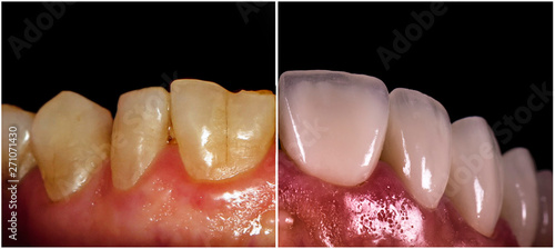 Φωτογραφία full ceramic veneers before and after