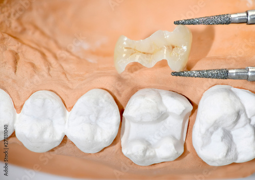 Inlay vor dem Einsetzten