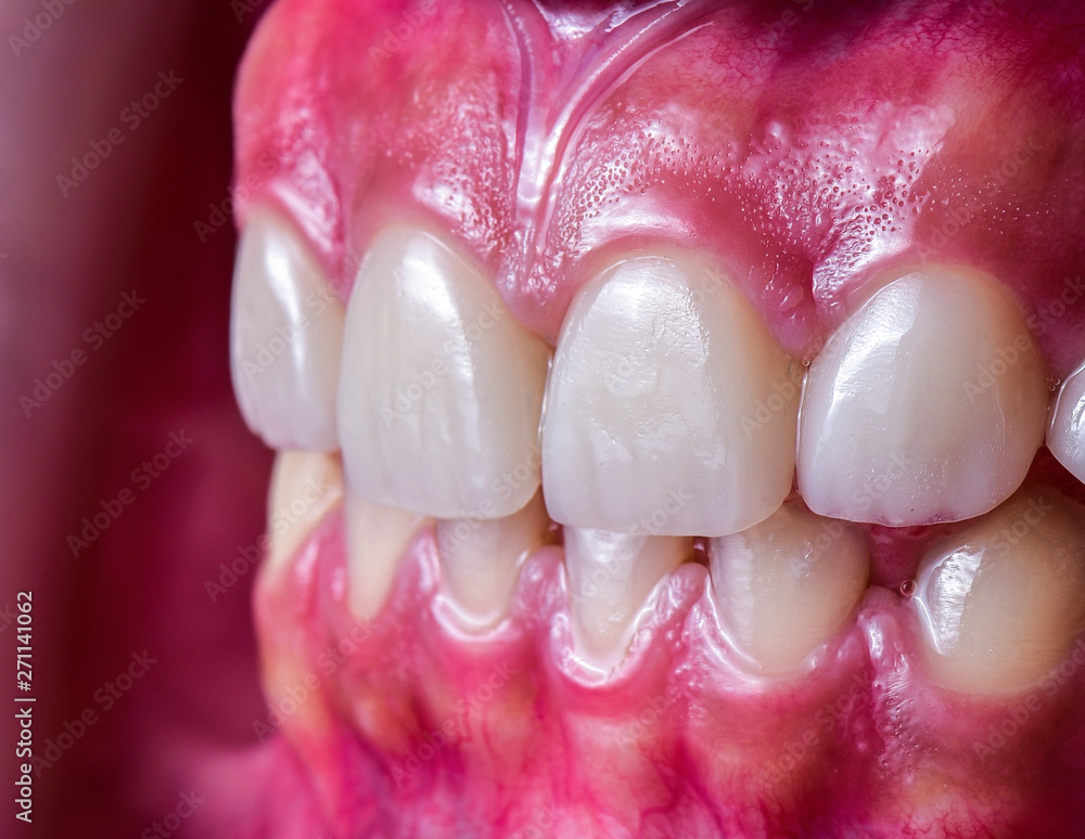 Obraz premium natural color 6 unit ceramic veneers