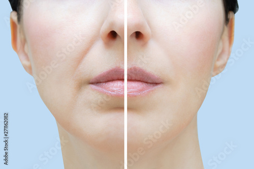 Nasolabial folds in a Caucasian woman. Face close up. Before and after.