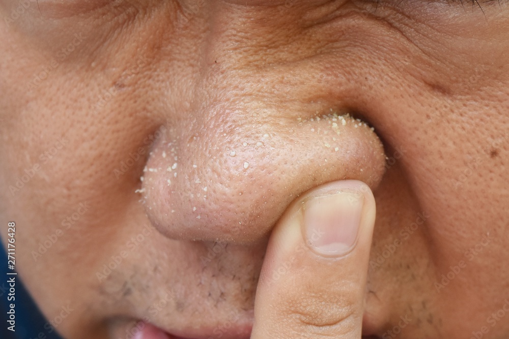 acne vulgaris on nose of asian man