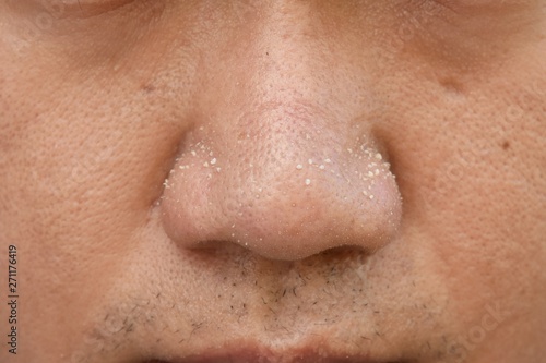 acne vulgaris on nose of asian man