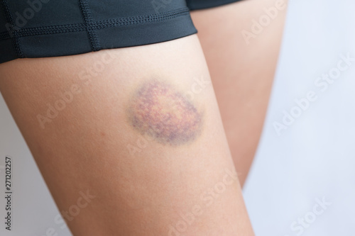 people with bruised leg closeup photo