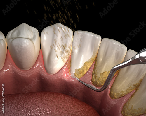 Oral hygiene: Ultrasonic teeth cleaning machine removing calculus and plaque. Medically accurate 3D illustration of human teeth treatment