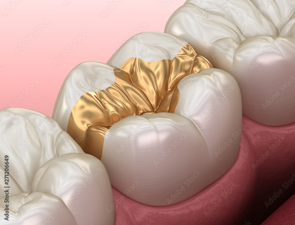 Golden Inlay crown fixation over tooth. Medically accurate 3D illustration of human teeth treatment Golden Inlay crown fixation over tooth. Medically accurate 3D illustration of human teeth treatment