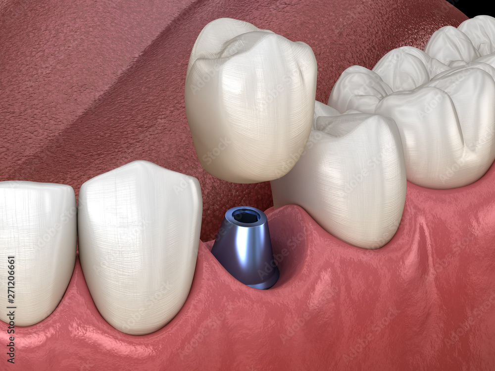 Premolar tooth recovery with implant. Medically accurate 3D illustration of human teeth and dentures concept Premolar tooth recovery with implant. Medically accurate 3D illustration of human teeth and dentures concept