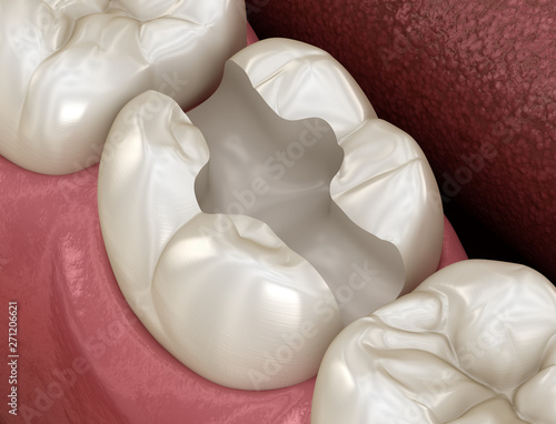 Tooth preparation for inlay placement. Medically accurate 3D illustration of human teeth treatment