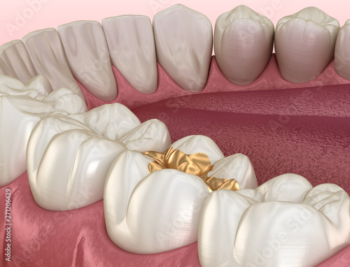 Golden Inlay crown fixation over tooth. Medically accurate 3D illustration of human teeth treatment