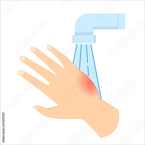 Burned skin on the hand. First aid after the accident