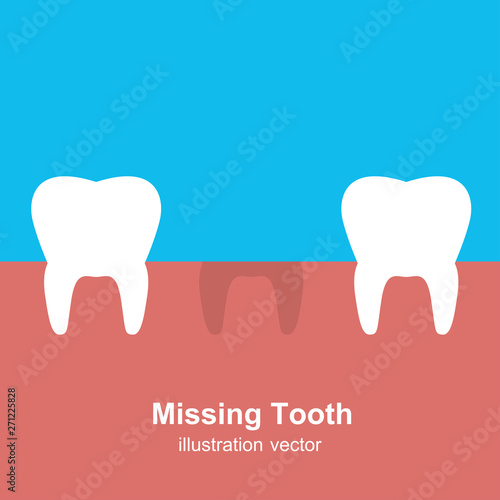 A Single Missing Tooth  Illustration Vector