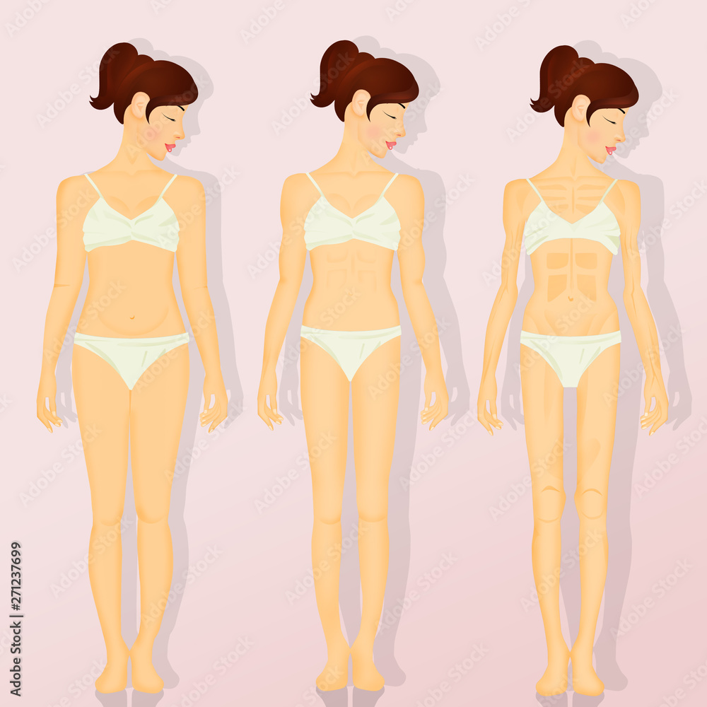 illustration of anorexia illustration of anorexia